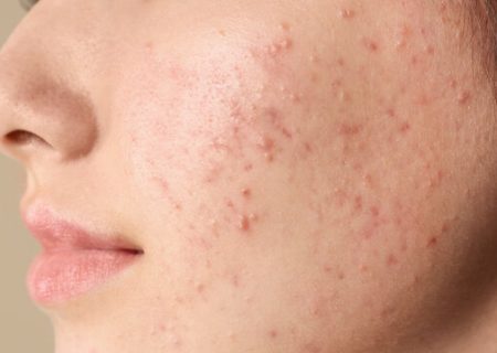 رابطه عوارض پوستی با تغذیه ناسالم