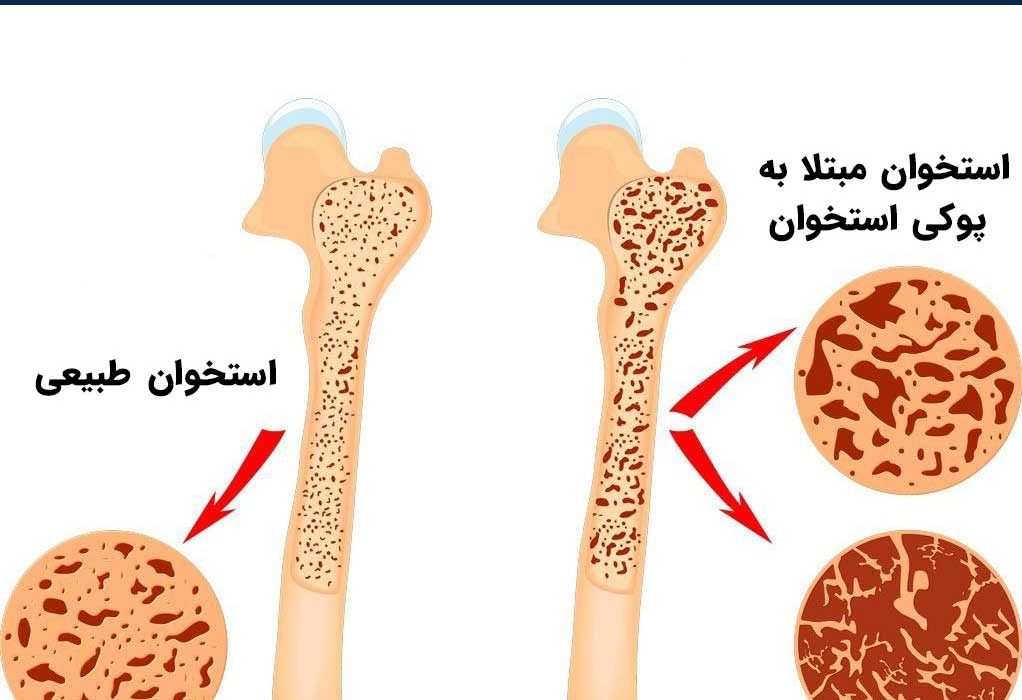 پیشگیری از پوکی استخوان را از جوانی آغاز کنیم