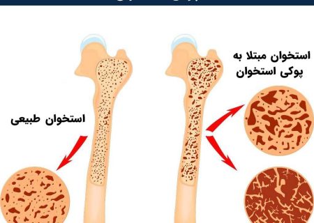 پیشگیری از پوکی استخوان را از جوانی آغاز کنیم
